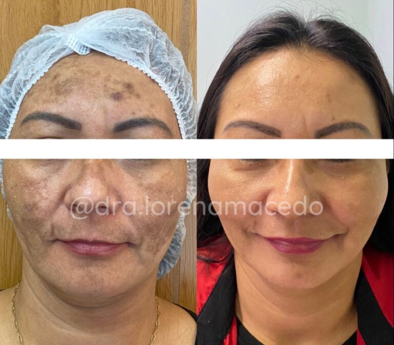 Harmonização Facial Dra. Lorena Macedo Belém PA