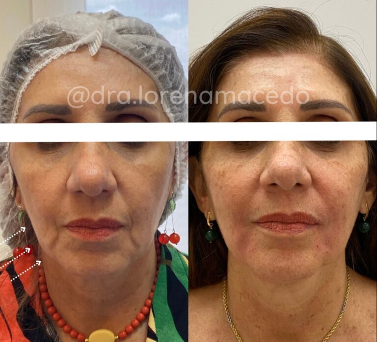 Harmonização Facial Dra. Lorena Macedo em Belém