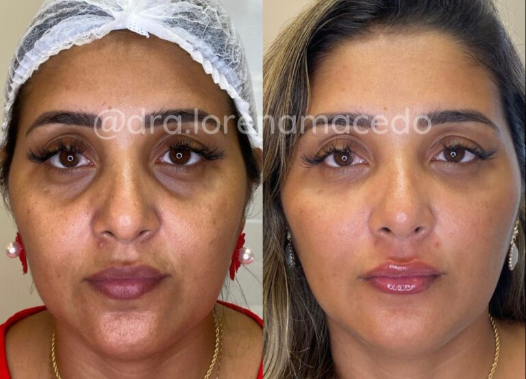 Harmonização Facial Dra. Lorena Macedo Belém