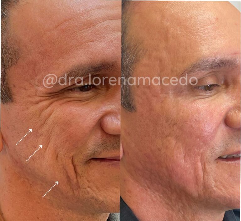 Remoção de Pés de Galinha Harmonização Facial Dra. Lorena Macedo