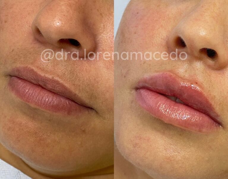 Harmonização Facial Dra. Lorena Macedo