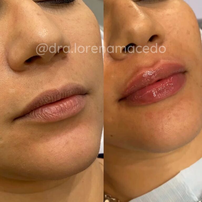 Aumento de Lábios Harmonização Facial Dra. Lorena Macedo