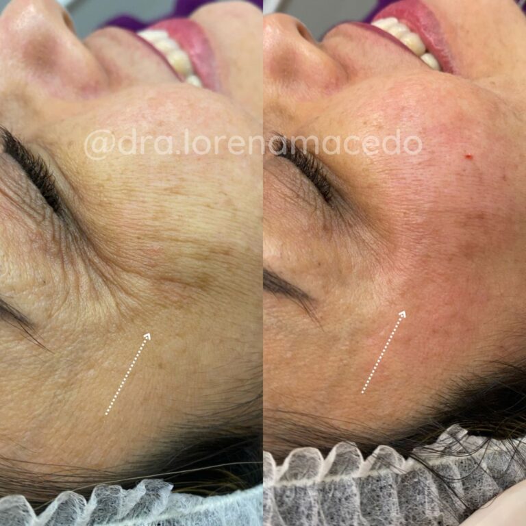 Remoção de Pé de galinha Harmonização Facial Dra. Lorena Macedo