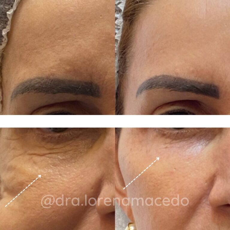 Redução de Rugas Dra. Lorena Macedo Harmonização Facial