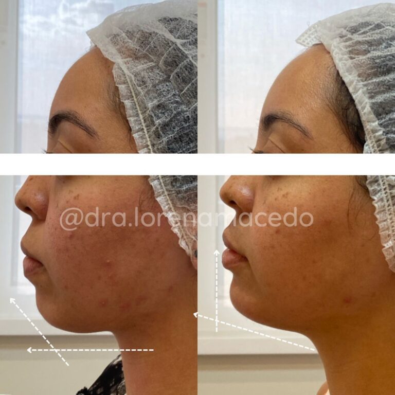 Harmonização Facial Dra. Lorena Macedo